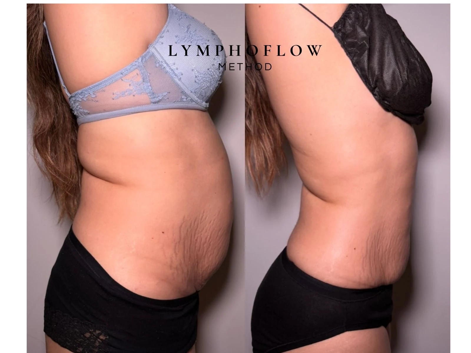 Antes y después lateral con bra azul y negro del protocolo Vientre Plano